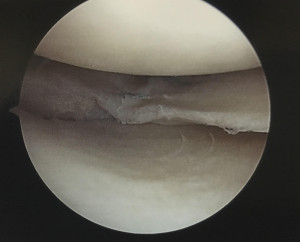Figure 2. Arthroscopic image following repair of a meniscus tear with three anchors and side to side sutures.