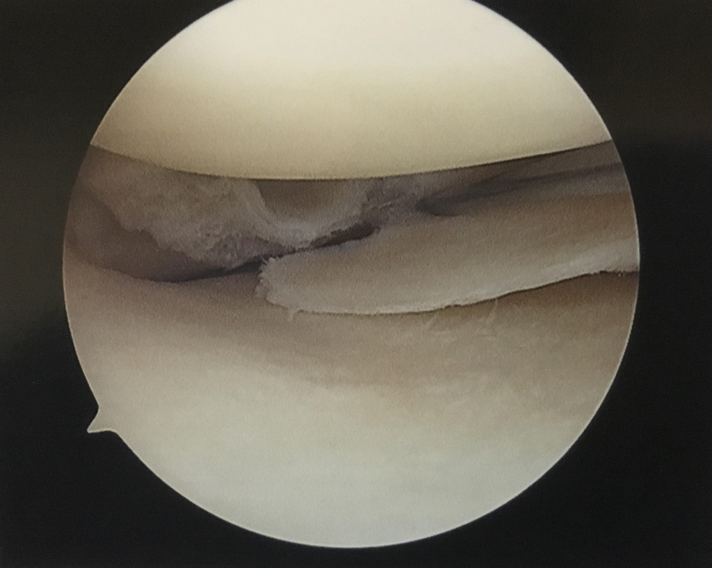 Arthroscopic image showing a radial tear in the posterior horn of the medial meniscus.